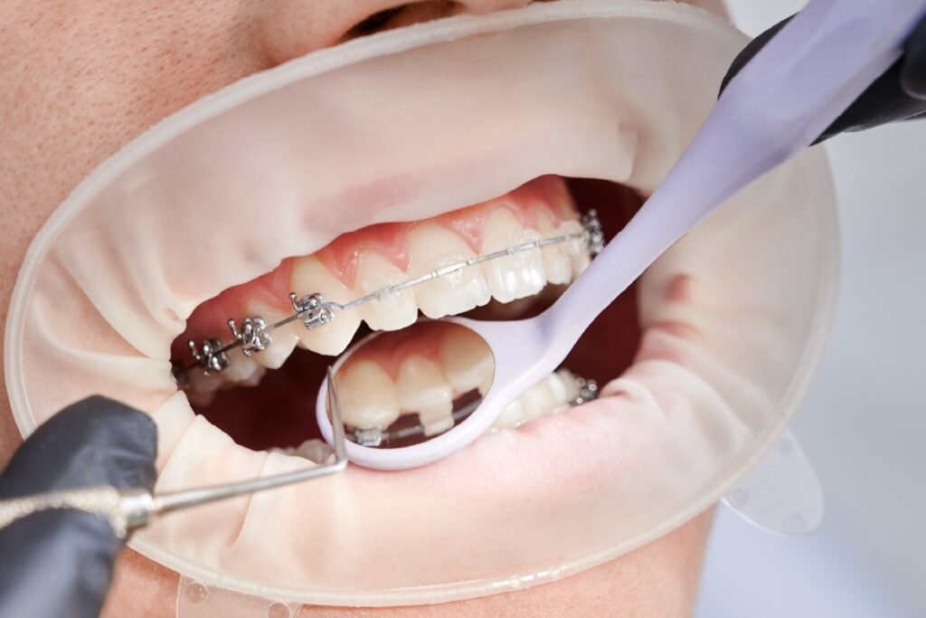 Orthodontic Treatment